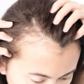 Understanding Female Hair Loss and Its Causes