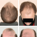 Understanding Genetics and Male Pattern Baldness: What You Need to Know