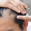 Understanding Hormonal Changes and Male Pattern Baldness