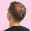 Male Pattern Baldness: Understanding Causes, Prevention, and Treatment Options