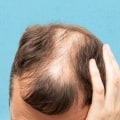 Understanding Hereditary Hair Loss: Causes, Prevention, and Treatment