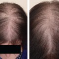 Understanding Female Pattern Hair Loss