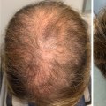 Hair Thickening Sprays: The Ultimate Solution for Hair Loss and Baldness