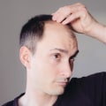 Lifestyle Changes to Prevent Male Pattern Baldness