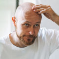 Exploring Medical Treatments for Male Pattern Baldness