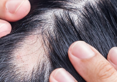 Alopecia: Understanding Hair Loss and Finding Solutions