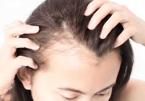 Understanding Female Hair Loss and Its Causes