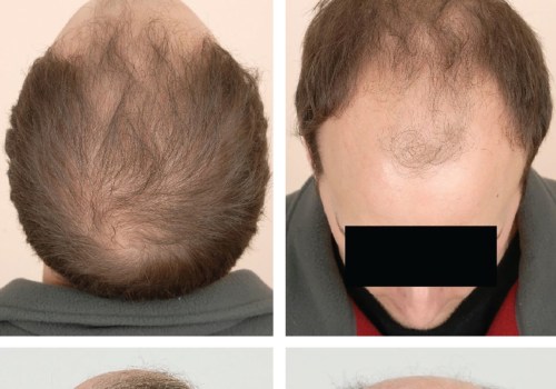 Understanding Genetics and Male Pattern Baldness: What You Need to Know