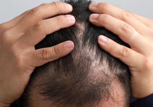 Understanding Stress and Hair Loss: Causes, Solutions, and Prevention