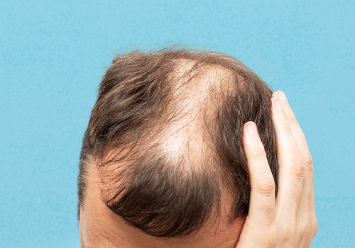 Lifestyle Factors and Male Pattern Baldness: What You Need to Know