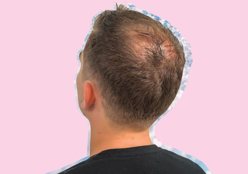 Male Pattern Baldness: Understanding Causes, Prevention, and Treatment Options