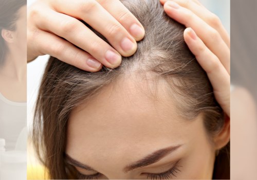 Pregnancy and Postpartum Hair Loss: Causes, Solutions, and Treatments