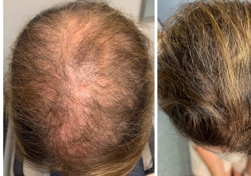 Hair Thickening Sprays: The Ultimate Solution for Hair Loss and Baldness