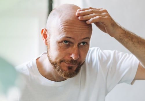 Exploring Medical Treatments for Male Pattern Baldness