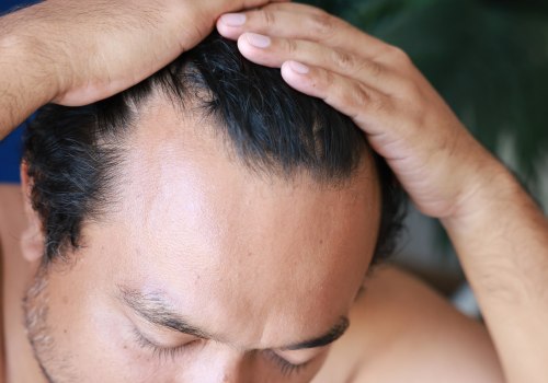 All About Finasteride: A Comprehensive Guide to Hair Loss Treatment